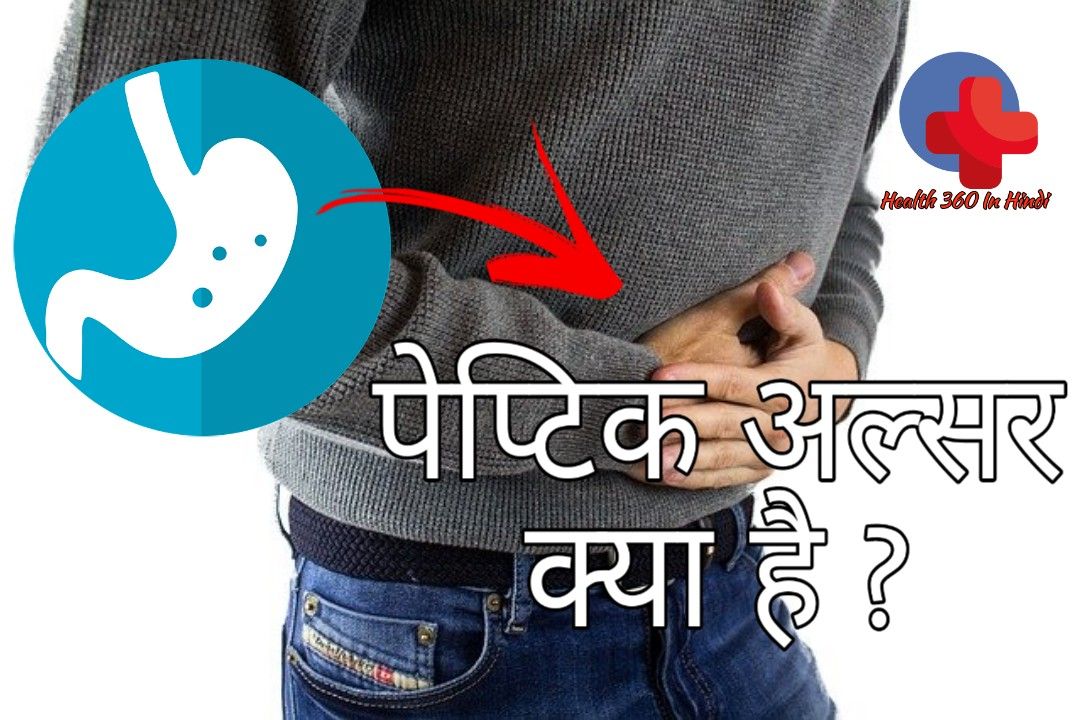 peptic ulcer in hindi