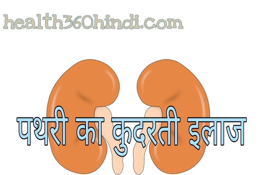 Natural cure of kidney stone in Hindi