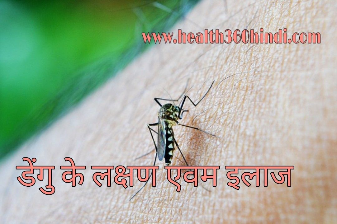 Dengue symptoms in Hindi