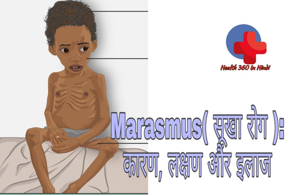 Marasmus in Hindi