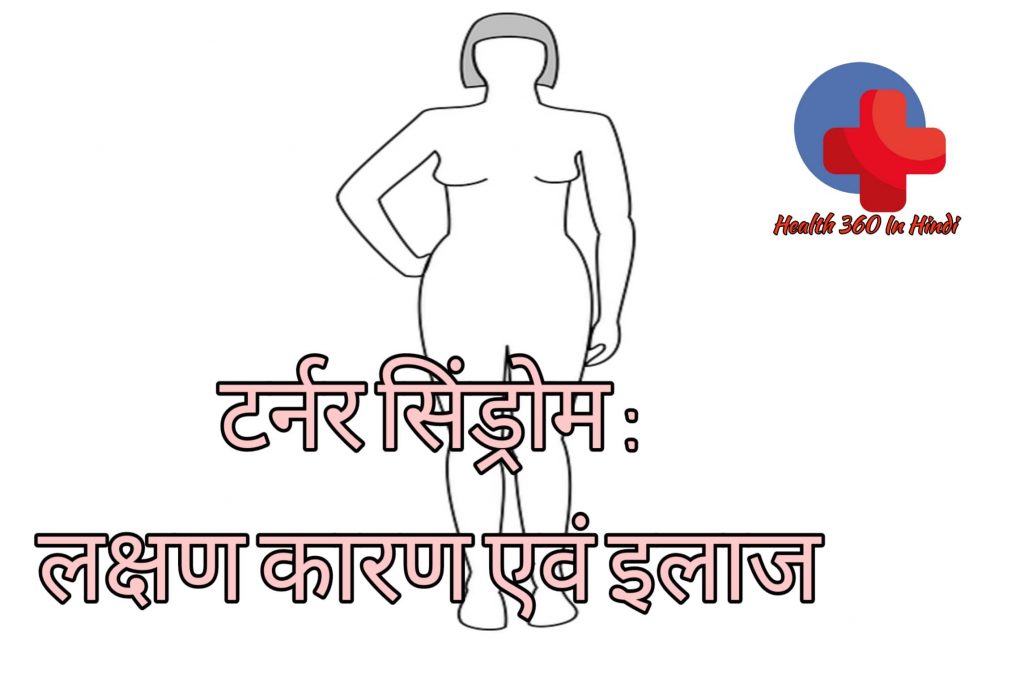 Turner Syndrome in Hindi