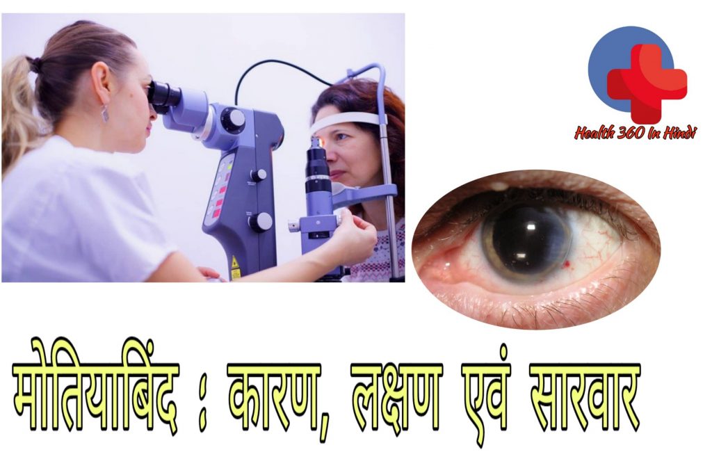 Cataract in Hindi