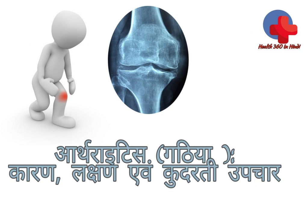 Arthritis Home Remedies in Hindi