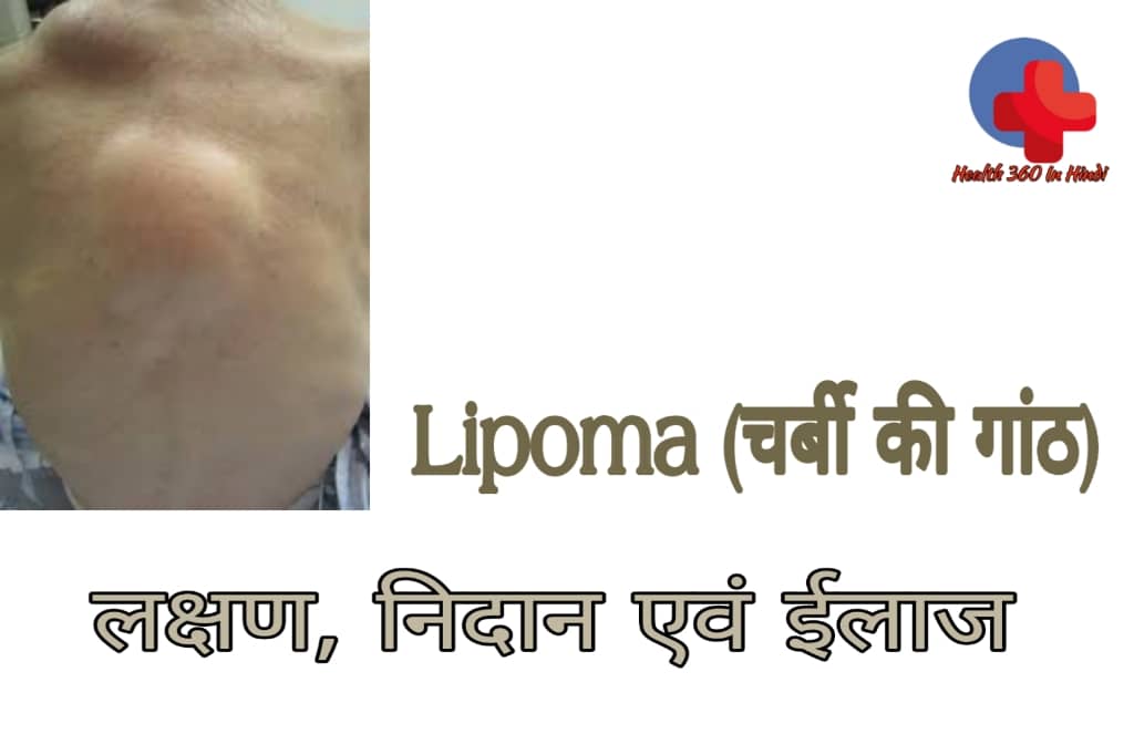 Lipoma in Hindi